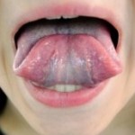 Folded Tongue
